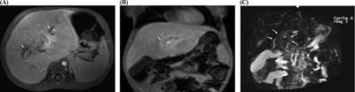 Liver transplantation in a child with sclerosing cholangitis due to Langerhans cell histiocytosis: a case report